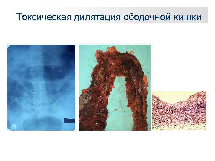 Токсическая дилятация ободочной кишки 