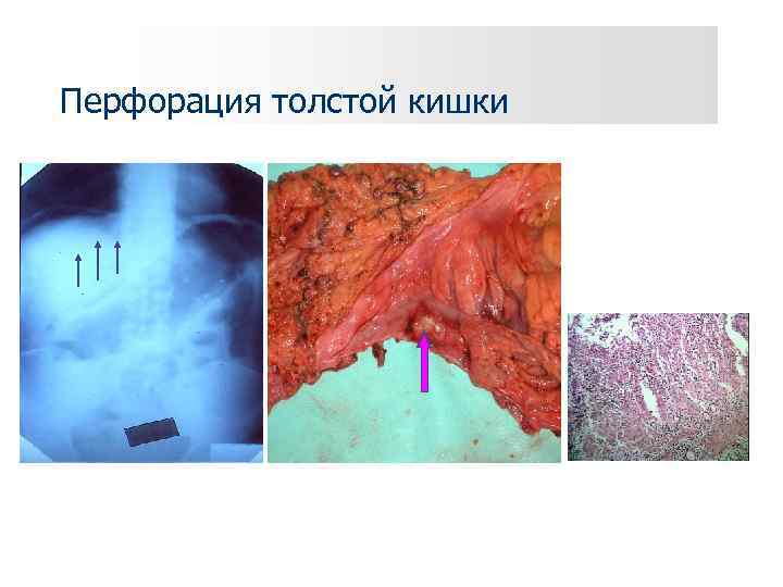 Перфорация толстой кишки 
