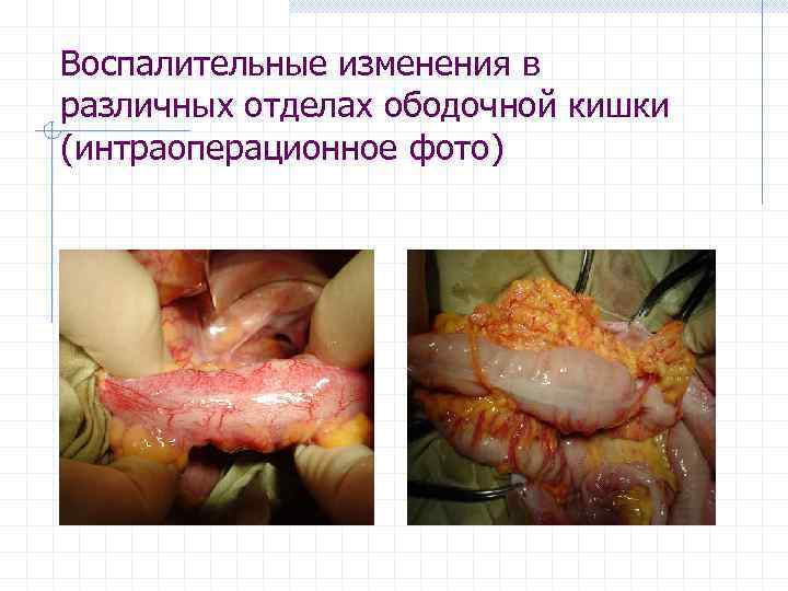 Воспалительные изменения в различных отделах ободочной кишки (интраоперационное фото) 