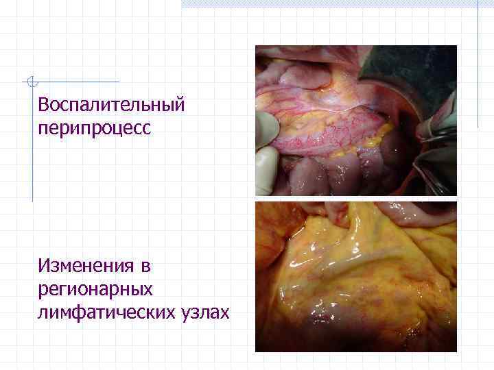 Воспалительный перипроцесс Изменения в регионарных лимфатических узлах 