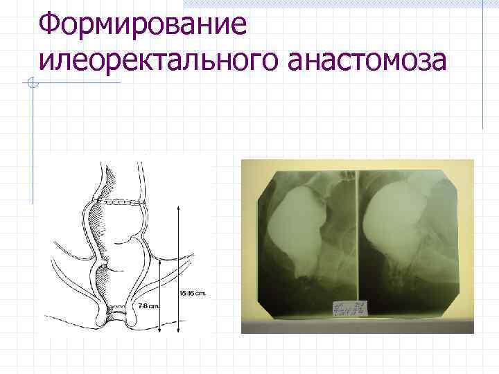 Формирование илеоректального анастомоза 
