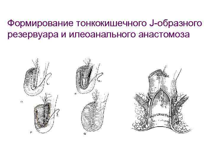 Формирование тонкокишечного J-образного резервуара и илеоанального анастомоза 