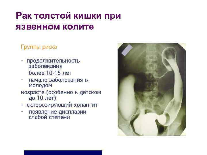 Рак толстой кишки при язвенном колите  Группы риска  - продолжительность заболевания более