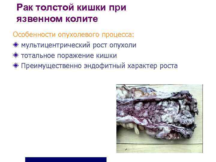 Рак толстой кишки при язвенном колите Особенности опухолевого процесса:  мультицентрический рост опухоли 