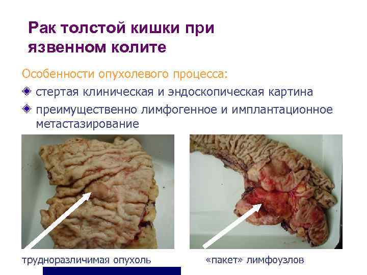  Рак толстой кишки при язвенном колите Особенности опухолевого процесса:  стертая клиническая и