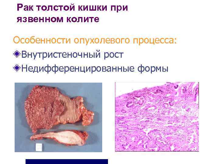 Рак толстой кишки при язвенном колите Особенности опухолевого процесса:  Внутристеночный рост Недифференцированные формы