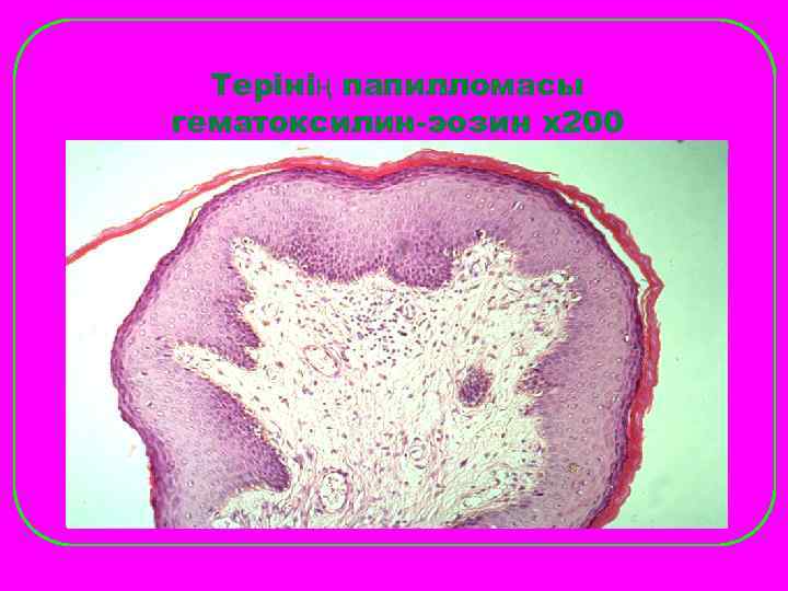  Терінің папилломасы гематоксилин-эозин х200 