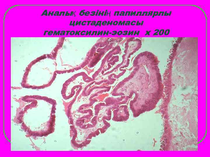 Аналық безінің папиллярлы цистаденомасы гематоксилин-эозин х 200 