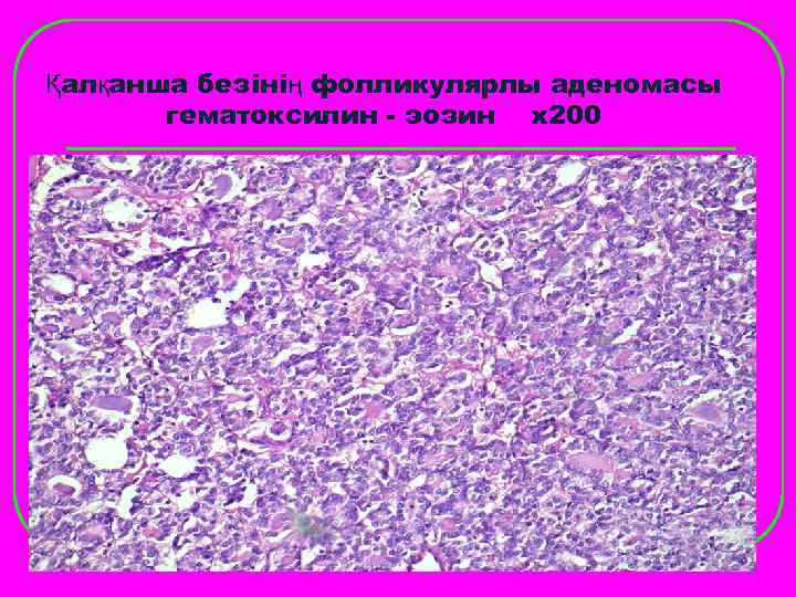 Қалқанша безінің фолликулярлы аденомасы  гематоксилин - эозин х200 