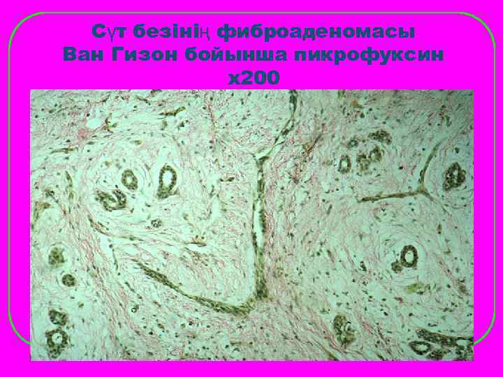  Сүт безінің фиброаденомасы Ван Гизон бойынша пикрофуксин    х200 
