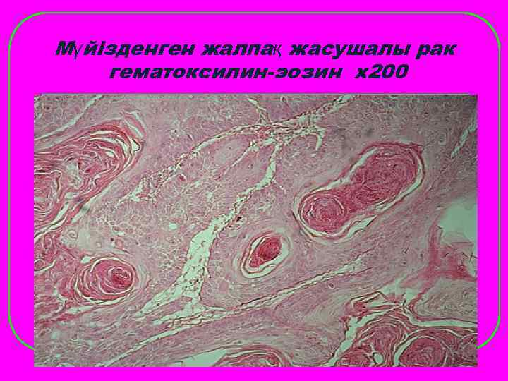 Мүйізденген жалпақ жасушалы рак гематоксилин-эозин х200 