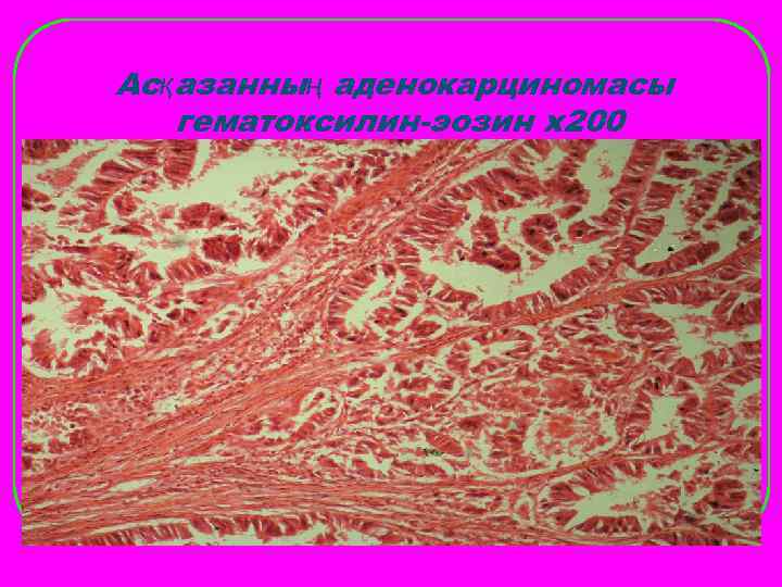 Асқазанның аденокарциномасы  гематоксилин-эозин х200 