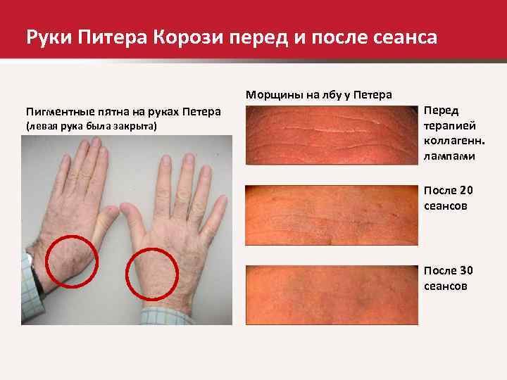 Руки Питера Корози перед и после сеанса       Морщины