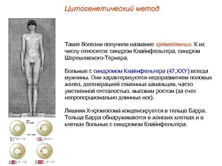 Цитогенетический метод  Такие болезни получили название хромосомных. К их числу относятся: синдром Клайнфельтера,