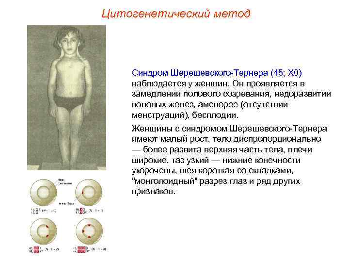 Цитогенетический метод   Синдром Шерешевского-Тернера (45; Х 0) наблюдается у женщин. Он проявляется