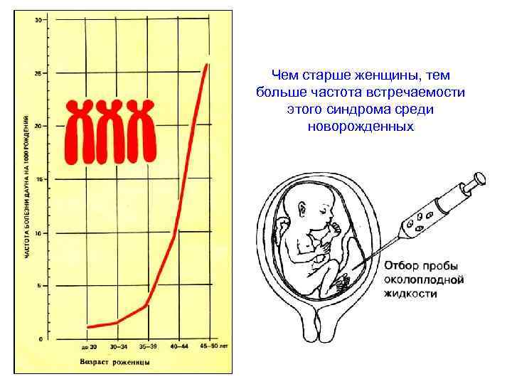  Чем старше женщины, тем больше частота встречаемости этого синдрома среди   новорожденных