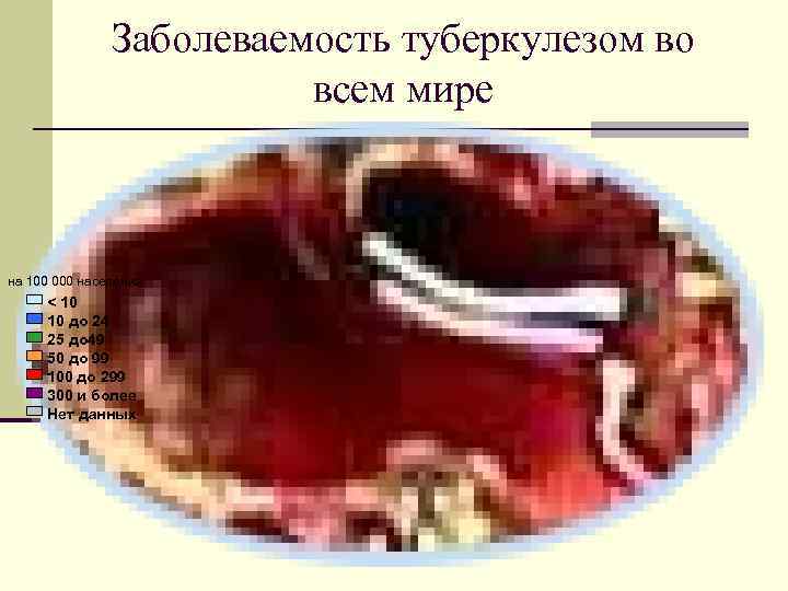     Заболеваемость туберкулезом во     всем мире 