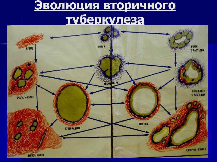 Эпид карта больного туберкулезом