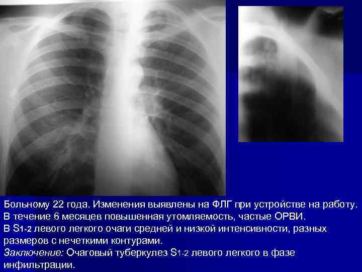 Как проверить легкие и бронхи кроме флюорографии