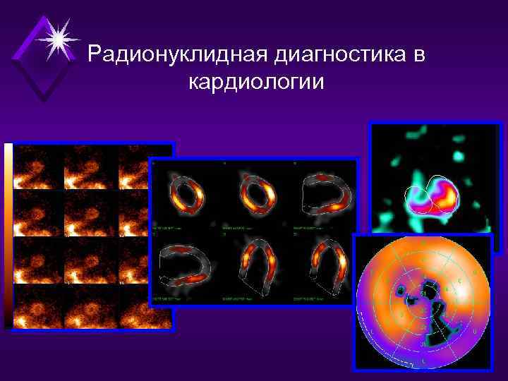 Радионуклидная диагностика в   кардиологии 