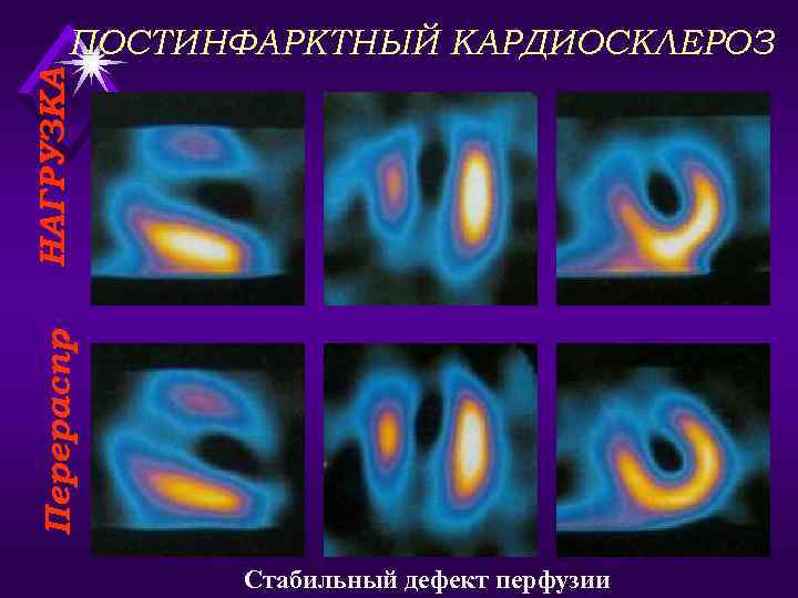  ПОСТИНФАРКТНЫЙ КАРДИОСКЛЕРОЗ НАГРУЗКА Перераспр  .    Стабильный дефект перфузии 