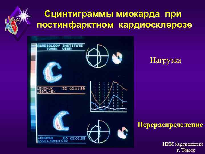  Сцинтиграммы миокарда при постинфарктном кардиосклерозе    Нагрузка    Перераспределение
