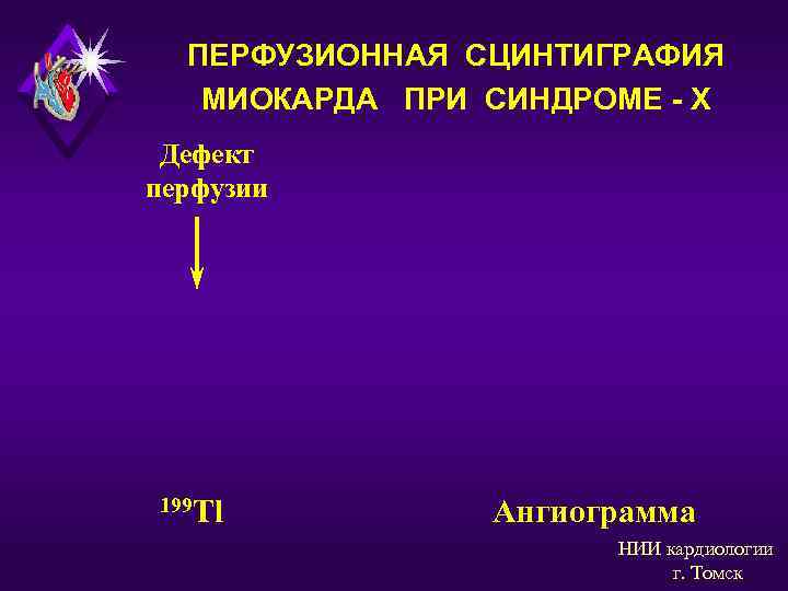  ПЕРФУЗИОННАЯ СЦИНТИГРАФИЯ  МИОКАРДА ПРИ СИНДРОМЕ - Х Дефект перфузии 199 Tl 
