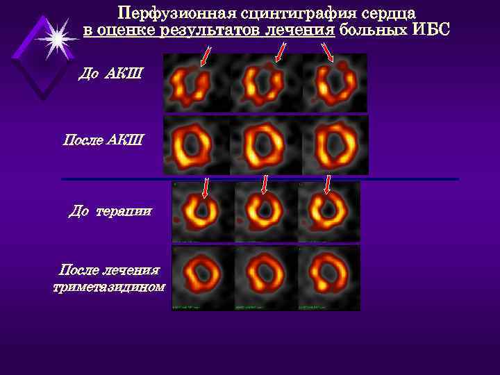   Перфузионная сцинтиграфия сердца  в оценке результатов лечения больных ИБС До АКШ