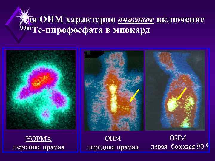  Для ОИМ характерно очаговое включение  99 m. Tc-пирофосфата в миокард  