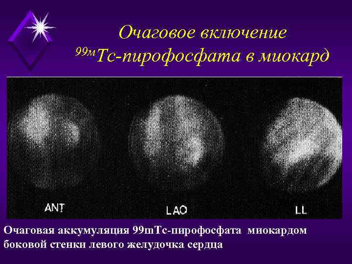     Очаговое включение  99 м. Тс-пирофосфата в миокард Очаговая аккумуляция