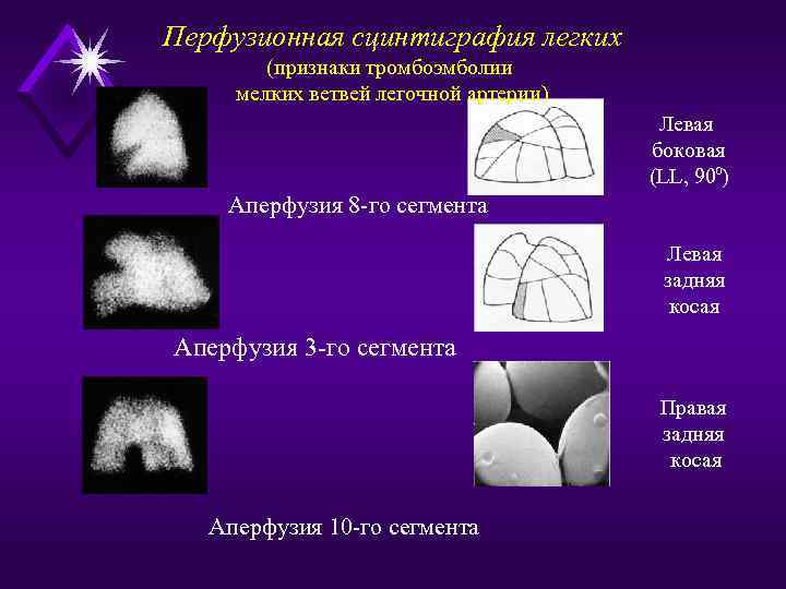 Перфузионная сцинтиграфия легких   (признаки тромбоэмболии мелких ветвей легочной артерии)   