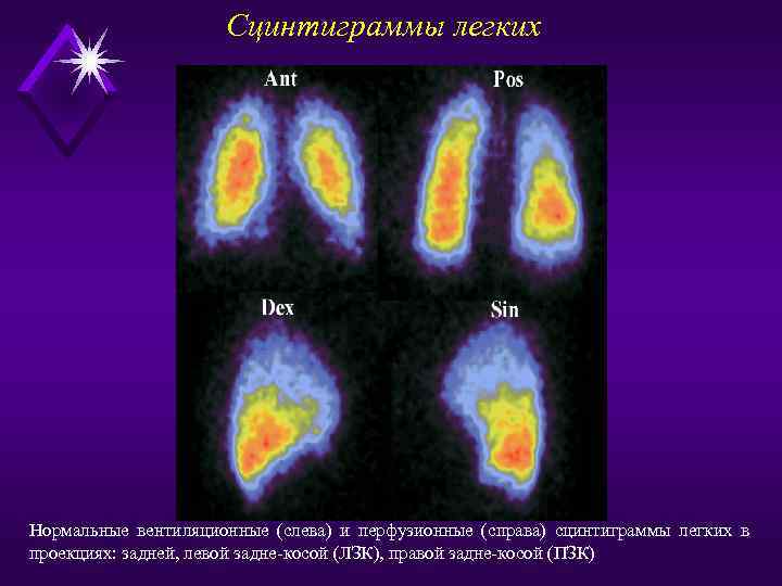 Сцинтиграмма является изображением