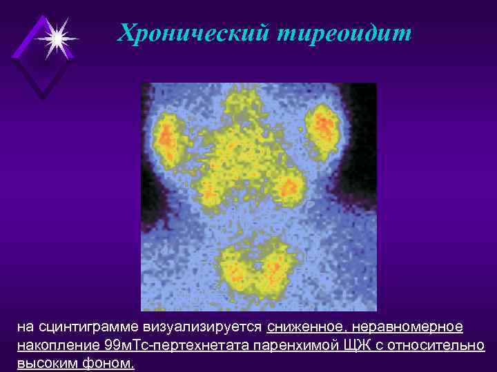   Хронический тиреоидит на сцинтиграмме визуализируется сниженное, неравномерное накопление 99 м. Тс-пертехнетата паренхимой