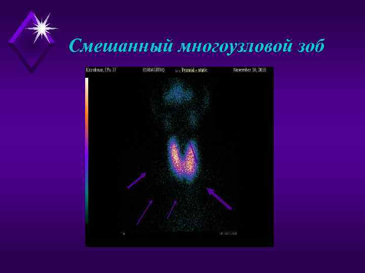 Смешанный многоузловой зоб 