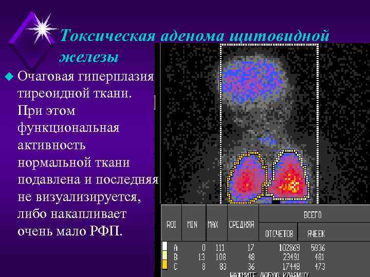  Токсическая аденома щитовидной  железы u Очаговаягиперплазия тиреоидной ткани.  При этом