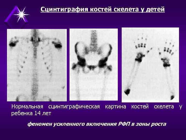 Сцинтиграфия скелета. Сцинтиграфия полипозиционная костей что это. Остеосцинтиграфия костей скелета норма. Радионуклидная диагностика костей скелета.