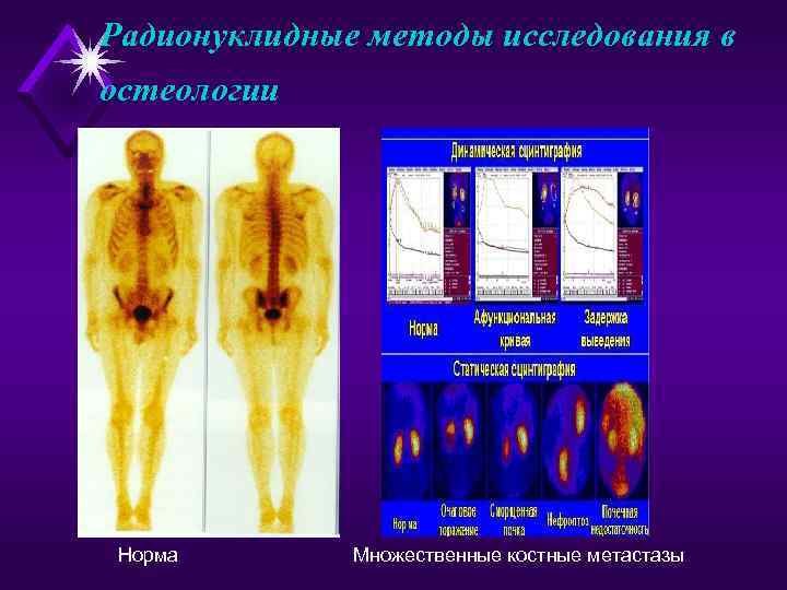 Радионуклидные методы исследования в остеологии Норма  Множественные костные метастазы 