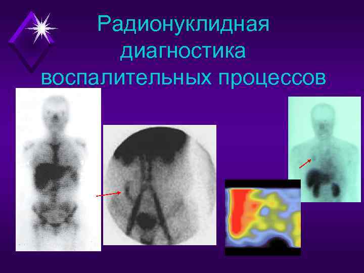  Радионуклидная  диагностика воспалительных процессов 