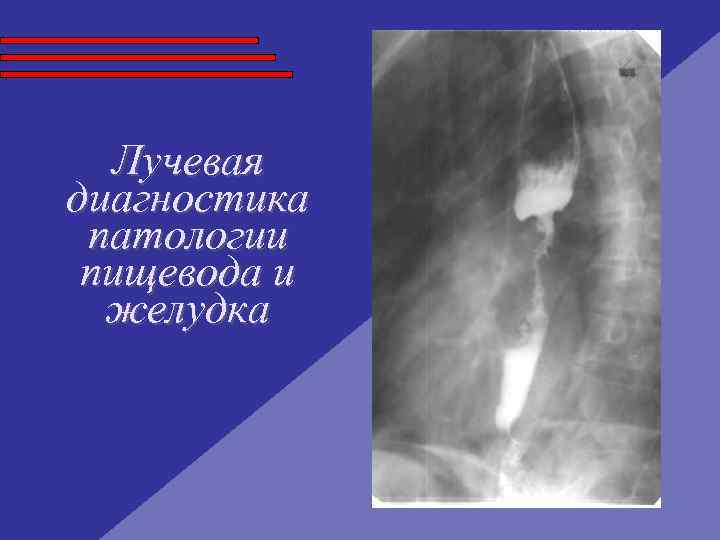 Лучевая диагностика патологии пищевода и желудка Лучевая диагностика патологии пищевода и желудка