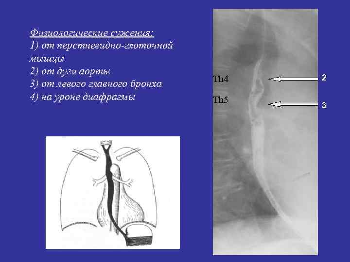 Физиологические сужения: 1) от перстневидно-глоточной мышцы 2) от дуги аорты Физиологические сужения: 1) от перстневидно-глоточной мышцы 2) от дуги аорты