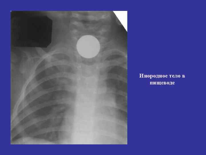 Инородное тело в пищеводе Инородное тело в пищеводе