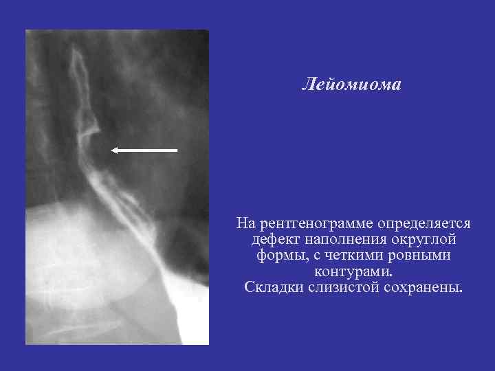 Лейомиома На рентгенограмме определяется дефект наполнения округлой формы, с четкими Лейомиома На рентгенограмме определяется дефект наполнения округлой формы, с четкими