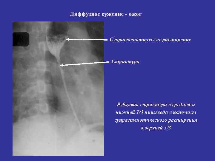 Диффузное сужение - ожог Супрастенотическое расширение Стриктура Диффузное сужение - ожог Супрастенотическое расширение Стриктура
