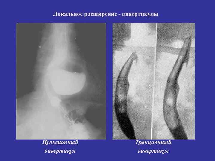 Локальное расширение - дивертикулы Пульсионный Тракционный дивертикул Локальное расширение - дивертикулы Пульсионный Тракционный дивертикул
