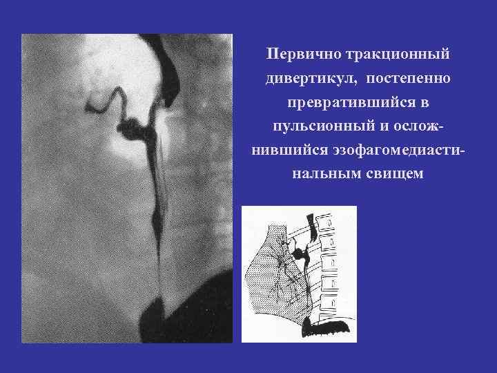 Первично тракционный дивертикул, постепенно превратившийся в пульсионный и ослож- нившийся эзофагомедиасти- Первично тракционный дивертикул, постепенно превратившийся в пульсионный и ослож- нившийся эзофагомедиасти-