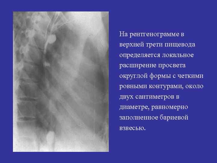 На рентгенограмме в верхней трети пищевода определяется локальное расширение просвета округлой формы с четкими На рентгенограмме в верхней трети пищевода определяется локальное расширение просвета округлой формы с четкими