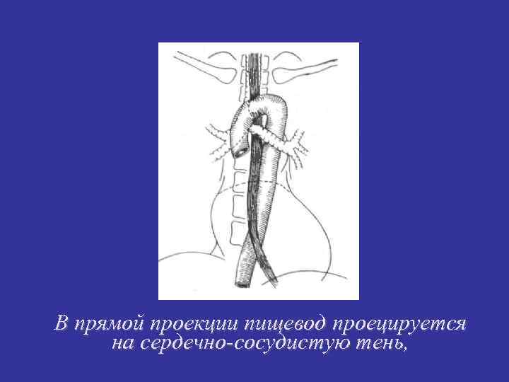 В прямой проекции пищевод проецируется на сердечно-сосудистую тень, В прямой проекции пищевод проецируется на сердечно-сосудистую тень,