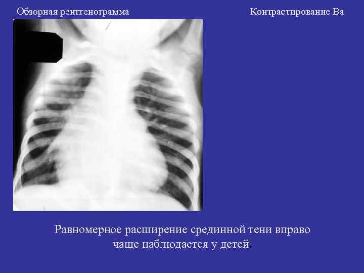 Обзорная рентгенограмма Контрастирование Ва Равномерное расширение срединной тени вправо Обзорная рентгенограмма Контрастирование Ва Равномерное расширение срединной тени вправо