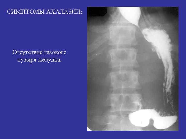 СИМПТОМЫ АХАЛАЗИИ: Отсутствие газового пузыря желудка. СИМПТОМЫ АХАЛАЗИИ: Отсутствие газового пузыря желудка.