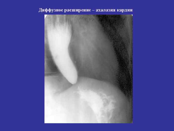 Диффузное расширение – ахалазия кардии Диффузное расширение – ахалазия кардии